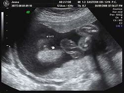 Image result for 3 Month Pregnancy Ultrasound