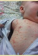 Image result for Baby Bed Bug Bites