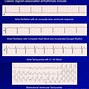 Image result for AFib vs V-fib