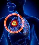 Image result for Lung Cancer On CT