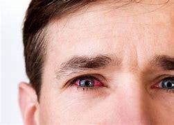 Image result for Allergic Conjunctivitis Treatment