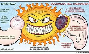 Image result for Squamous and Basal Cell Cancer