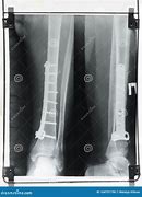 Image result for X-ray of Leg with Metal Plates