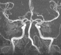 Image result for Vertebral Dissection On Angiogram