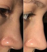 Image result for Blackhead Removal Before and After