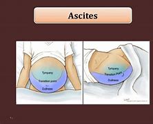 Image result for Thoracic Empyema On Percussion