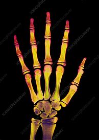 Image result for Child's Hand X-ray