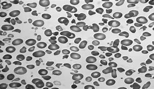 Image result for Pyropoikilocytosis