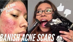 Image result for Banish Acne Scars