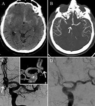 Image result for Aneurysm in MRI