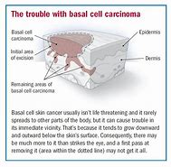 Image result for Basal Cell Carcinoma Cancer Symptoms