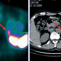 Image result for MIBG Pheochromocytoma