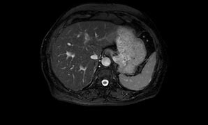 Image result for IRM Abdominale