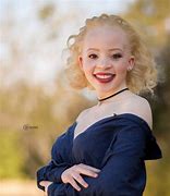 Image result for South African Albino