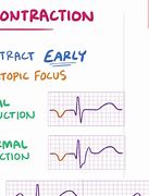 Image result for Premature Atrial Contraction