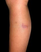 Image result for Lower Leg Pustules