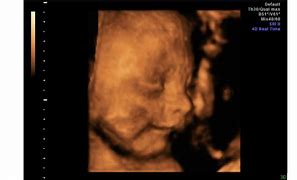 Image result for 4D Ultrasound at 15 Weeks