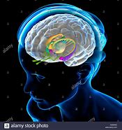 Image result for CT Brain Lentiform Nucleus