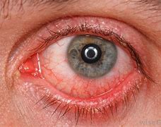 Image result for High Blood Pressure Eye Symptoms