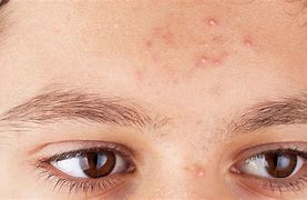 Image result for How to Get Rid Acne Bumps