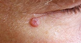 Image result for Early Basal Cell Skin Cancer