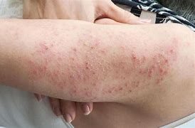 Image result for Diabetic Rash