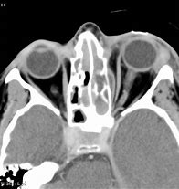 Image result for Subperiosteal Abscess Orbital Cellulitis