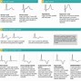 Image result for SVT vs VT ECG