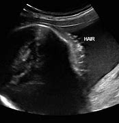 Image result for 3 Month Pregnancy Ultrasound