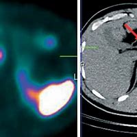 Image result for MIBG Pheochromocytoma