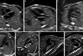 Image result for Abnormal Fetal Heart Ultrasound