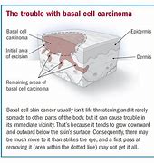 Image result for Basal Cell Carcinoma Cancer Symptoms