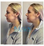 Image result for 1 Ml Chin Filler