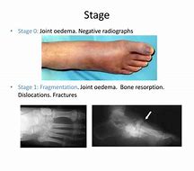 Image result for Charcot Bone Disease