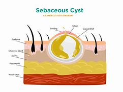 Image result for Sebaceous Cyst Drawing