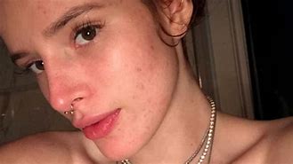 Image result for Bella Thorne Acne