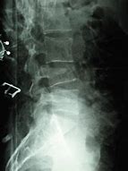 Image result for Compression Fracture Lumbar Surgery