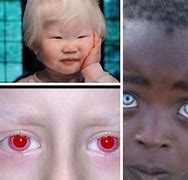 Image result for albino child eyes