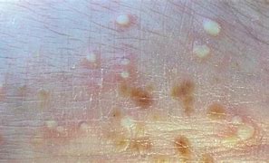 Image result for Pustular Skin