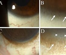 Image result for Limbus Cornea