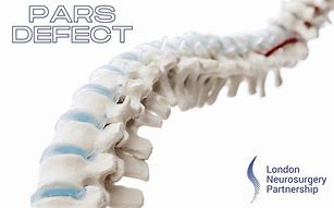 Image result for Pars Defect Lumbar Spine