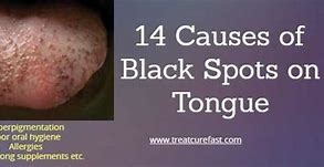 Image result for Blood Spots Under Tongue