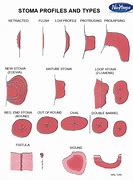 Image result for Double Barrel Stoma