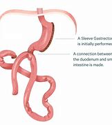 Image result for Sadi Gastric Surgery