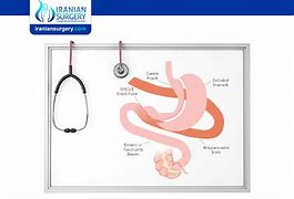 Image result for Sadi S Surgery