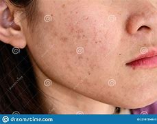 Image result for Acne On Side of Face