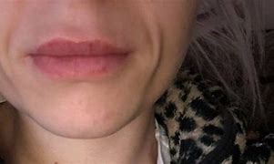 Image result for Bad Lip Fillers