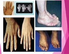 Image result for Gigantism Acromegaly and Dwarfism