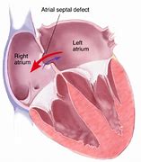 Image result for Atrial Septal Defect Blood Flow