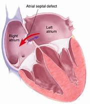 Image result for Interatrial Septum Anatomy